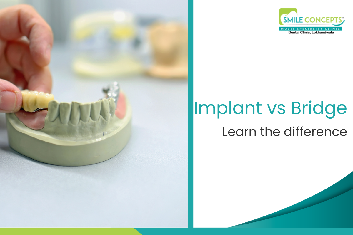 Dental Implants vs Bridges