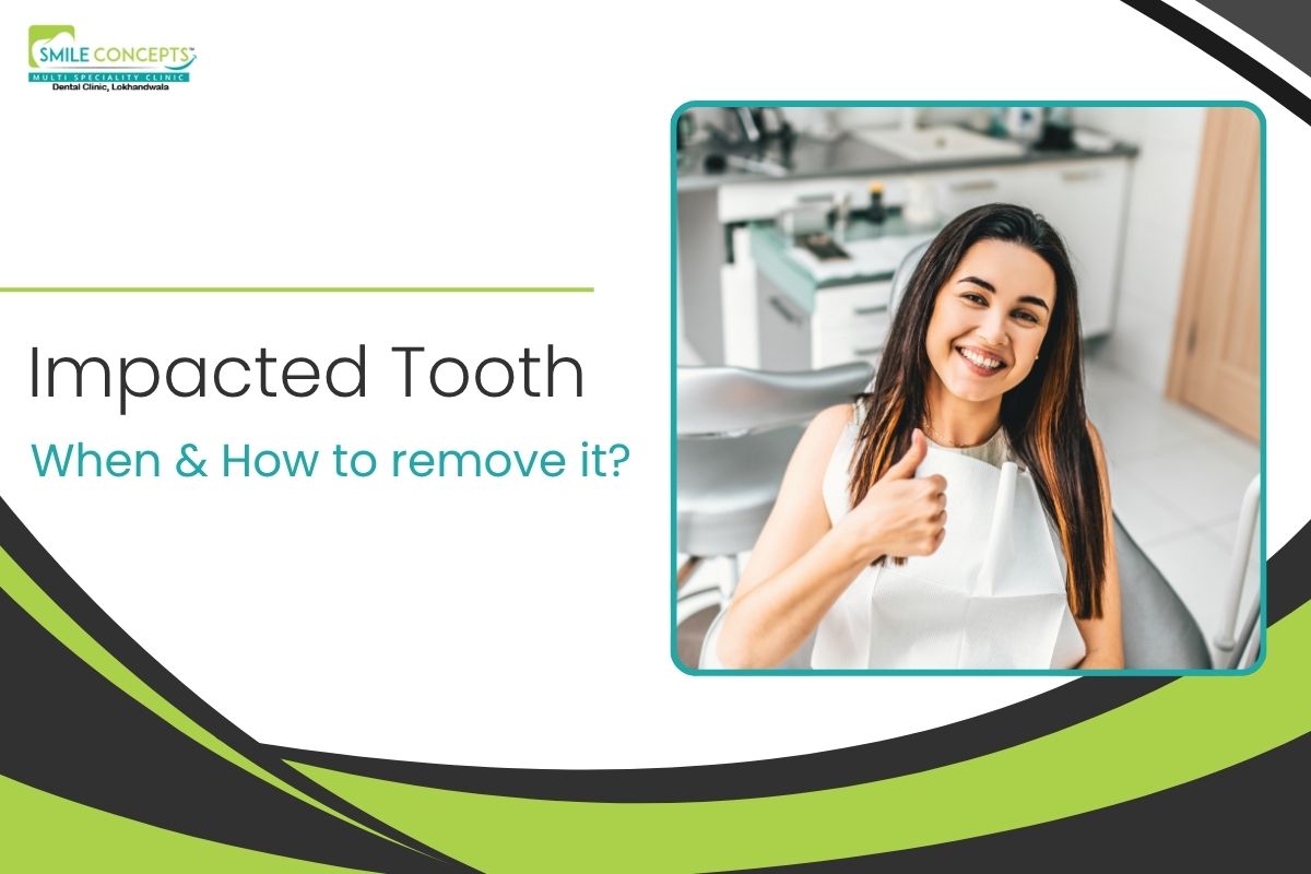 Impacted Tooth Removal